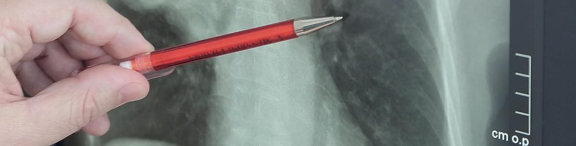 Herausforderungen bei der Diagnostik von Lungenkrebs - Video