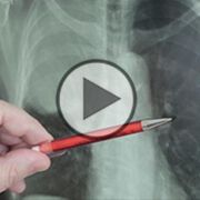 Herausforderungen bei der Diagnostik von Lungenkrebs - Video