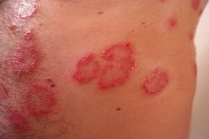 Die Schuppenflechte (Psoriasis) - Ursachen, Behandlung und neue Therapieansätze