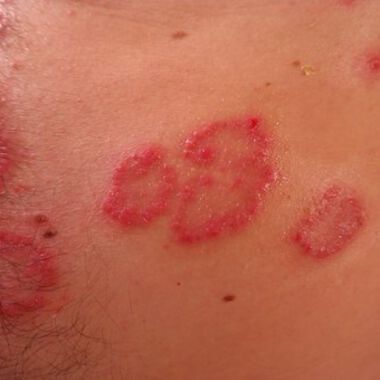 Die Schuppenflechte (Psoriasis) - Ursachen, Behandlung und neue Therapieansätze