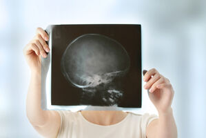 Epilepsie: Gendefekte zeigen Therapierelevanz an