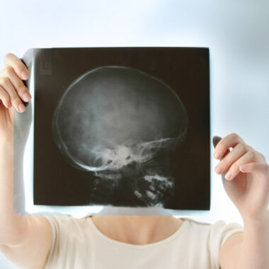 Epilepsie: Gendefekte zeigen Therapierelevanz an