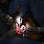 Bypass bei schwerer koronarer Herzkrankheit einem Stent vorzuziehen