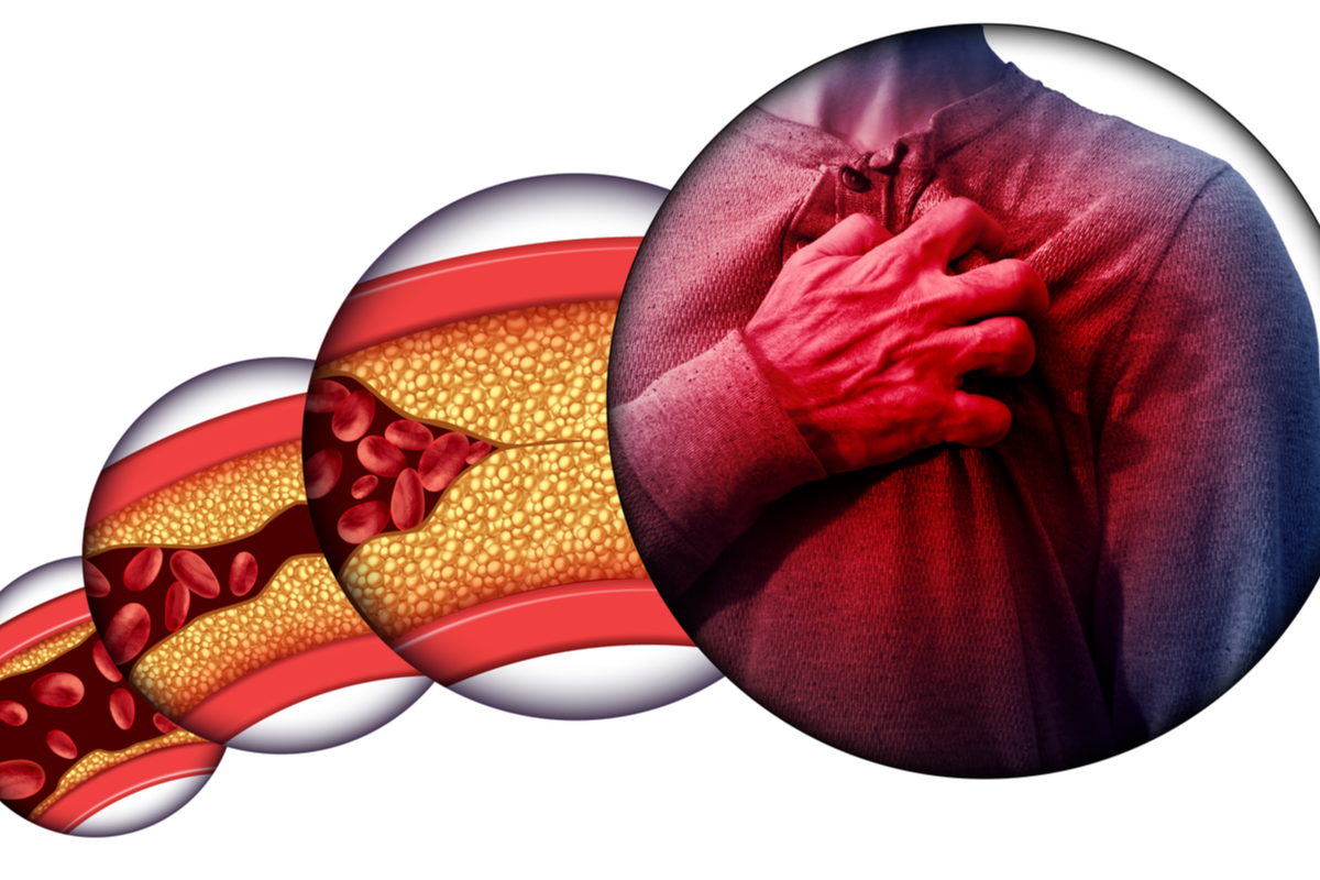 Arteriosklerose – Ursachen und Diagnose