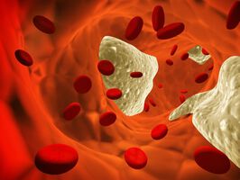 Arteriosklerose – Ursachen und Diagnose