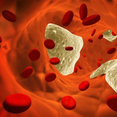Arteriosklerose – Ursachen und Diagnose