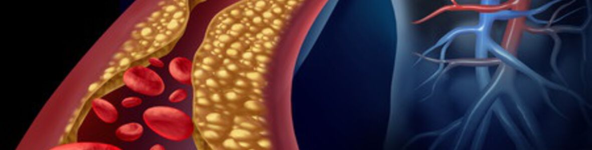 Arteriosklerose – Ursachen und Diagnose