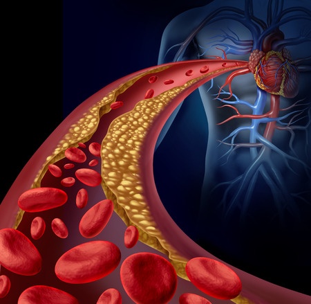 Arteriosklerose – Ursachen und Diagnose