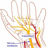 Karpaltunnelsyndrom: Wenn die Hand ständig einschläft