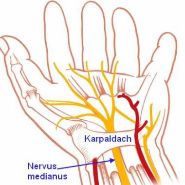 Karpaltunnelsyndrom: Wenn die Hand ständig einschläft