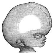 Hydrocephalus – entscheidender Mechanismus für Entstehung eines Wasserkopfes entdeckt