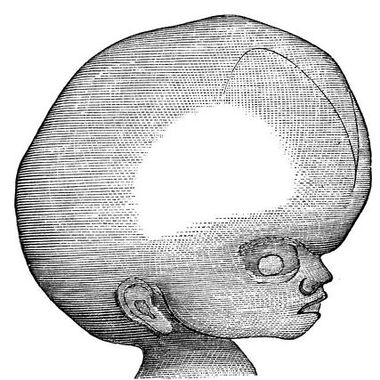Hydrocephalus – entscheidender Mechanismus für Entstehung eines Wasserkopfes entdeckt