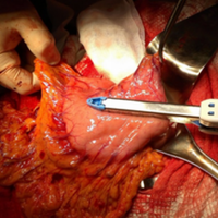 Treatment of esophageal anastomotic leakage on the neck