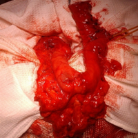 Esophagogastroplasty as the second step of surgical treatment