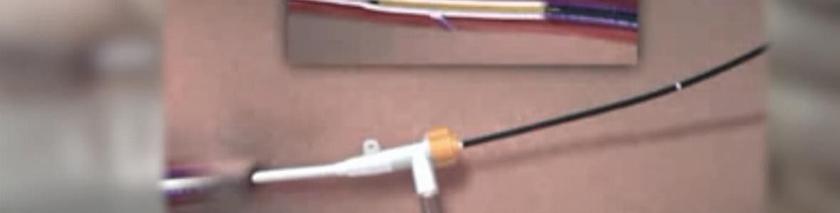 Stammvenenerkrankung – Therapie von einst und heute (VIDEO)