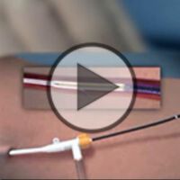 Stammvenenerkrankung – Therapie von einst und heute (VIDEO)