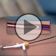 Stammvenenerkrankung – Therapie von einst und heute (VIDEO)