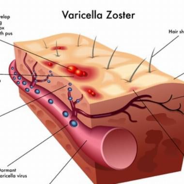 Herpes Zoster im Überblick