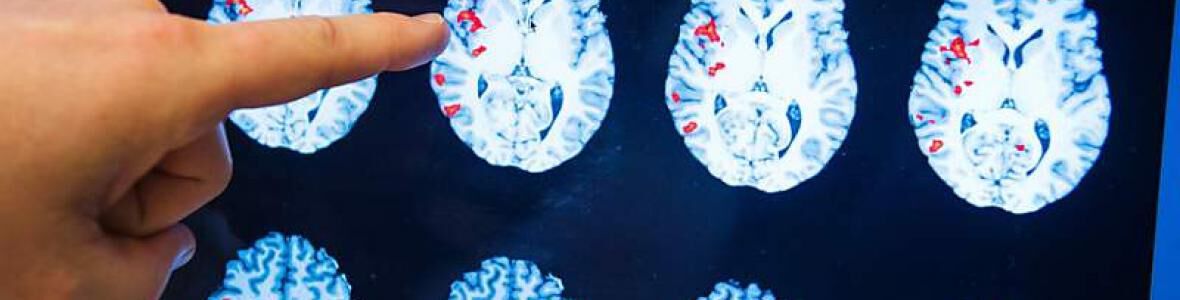 Studie: physikalische Gefäßtherapie BEMER® bei MS-bedingter Fatigue