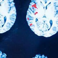 Studie: physikalische Gefäßtherapie BEMER® bei MS-bedingter Fatigue