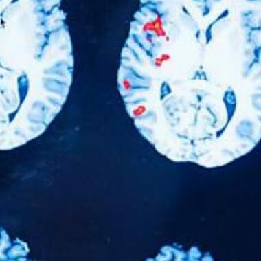 Studie: physikalische Gefäßtherapie BEMER® bei MS-bedingter Fatigue