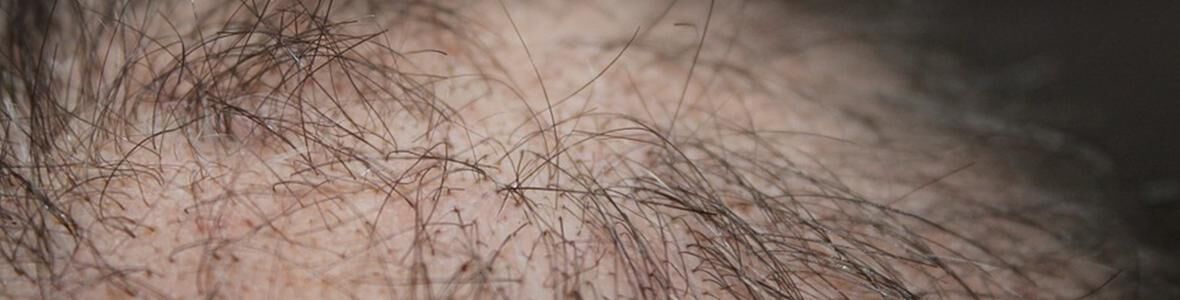 Haartransplantation