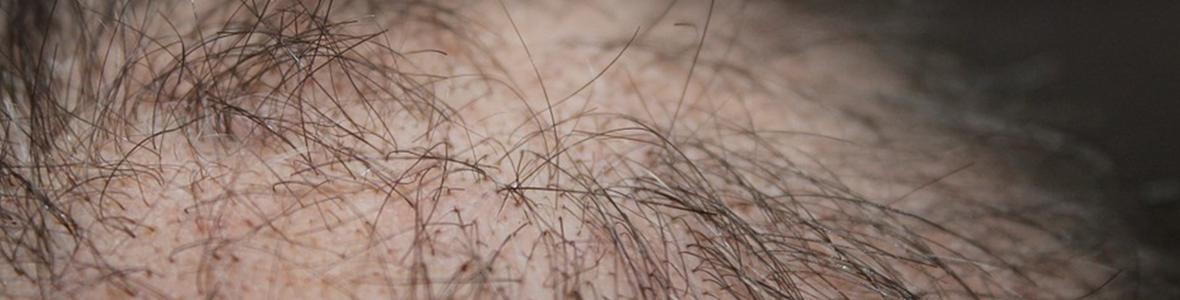 Haartransplantation
