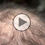 Haartransplantation