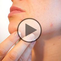 Akne - Die richtige Therapie - Video