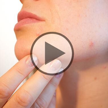 Akne - Die richtige Therapie - Video