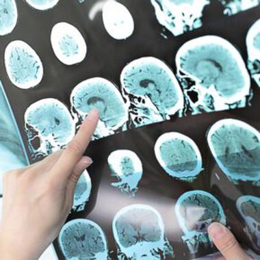 Welt-Schlaganfall-Tag: Aktiv gegen den Hirninfarkt – Wirksame Maßnahmen der Prävention