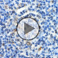 Neuentdeckung: Ursache für Lymphdrüsenkrebs - Video