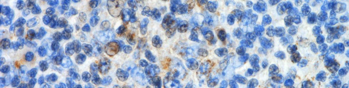 Neuentdeckung: Ursache für Lymphdrüsenkrebs - Video