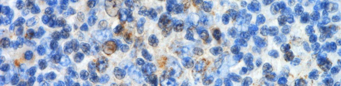Neuentdeckung: Ursache für Lymphdrüsenkrebs - Video