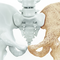Osteoporose: Früherkennung und Prävention (Video)