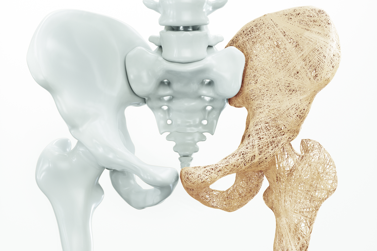 Osteoporose: Früherkennung und Prävention (Video)