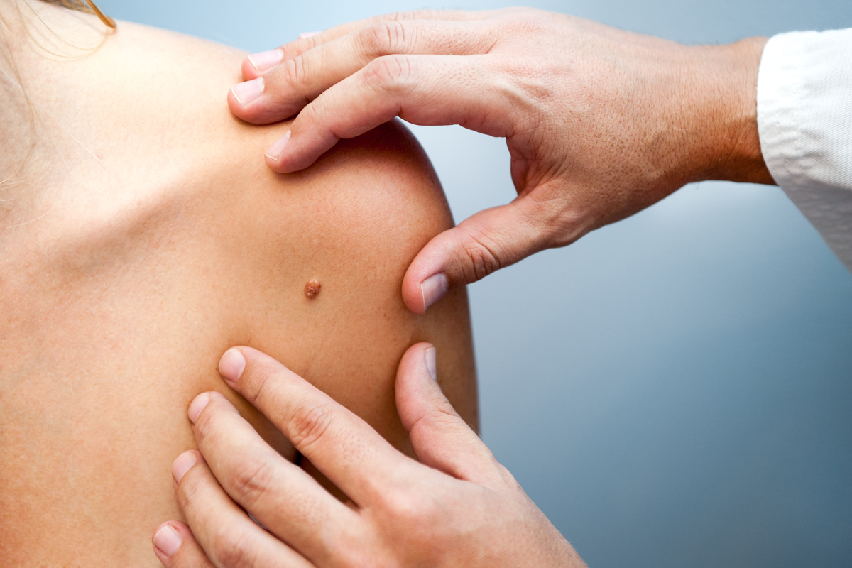 Hautkrebs-Diagnostik: automatische Diagnose von Melanomen