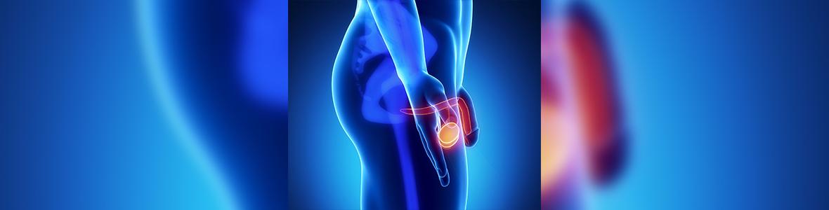 Gutartige Prostatavergrößerung - Video
