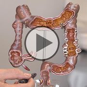 Dickdarmkrebs: die dritthäufigste Krebserkrankung - Video