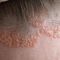 Gut leben mit Psoriasis: QualityCare, das Service- und Begleitprogramm für Betroffene