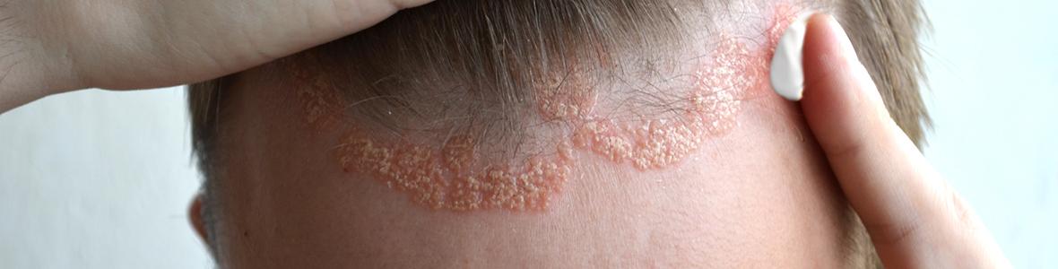 Gut leben mit Psoriasis: QualityCare, das Service- und Begleitprogramm für Betroffene