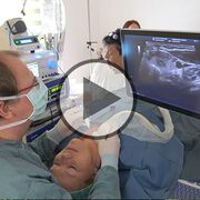 Radiofrequenzablation von Schilddrüsenknoten - Video