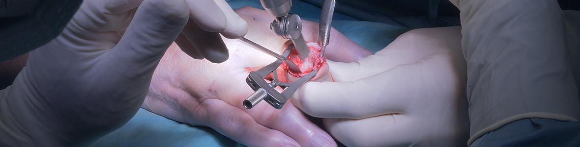 Abnützung Mittel und Endgelenke der Finger- Herberden und Bouchard Arthrose, Prof. Mathias Glehr