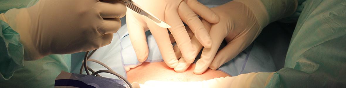 WHIPPLE OP am LKH Univ. Klinikum Graz - Video