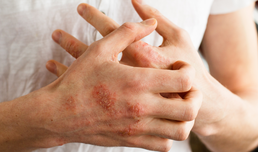 Leben mit Psoriasis ist wie …?