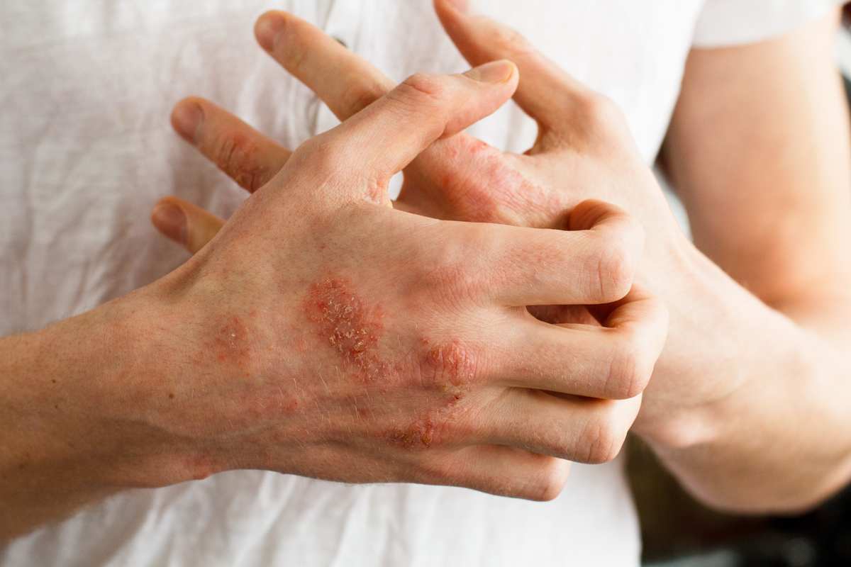 Leben mit Psoriasis ist wie …?