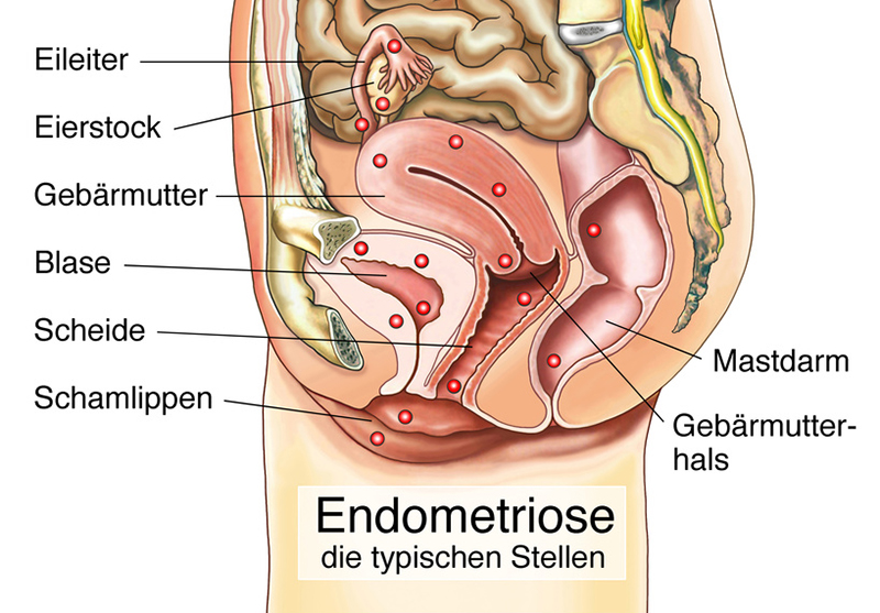 Endometriose: typische Stellen