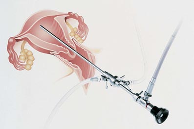 Hysteroskopie