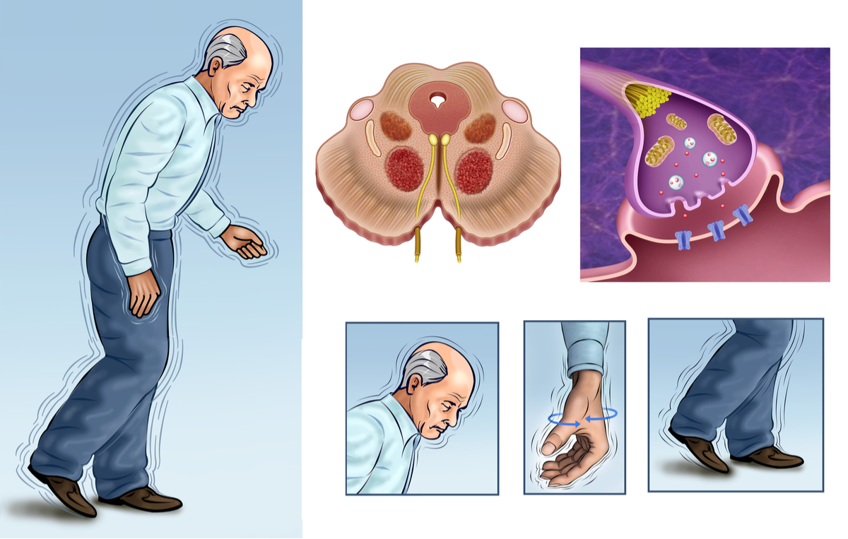 Symptome bei Parkinson