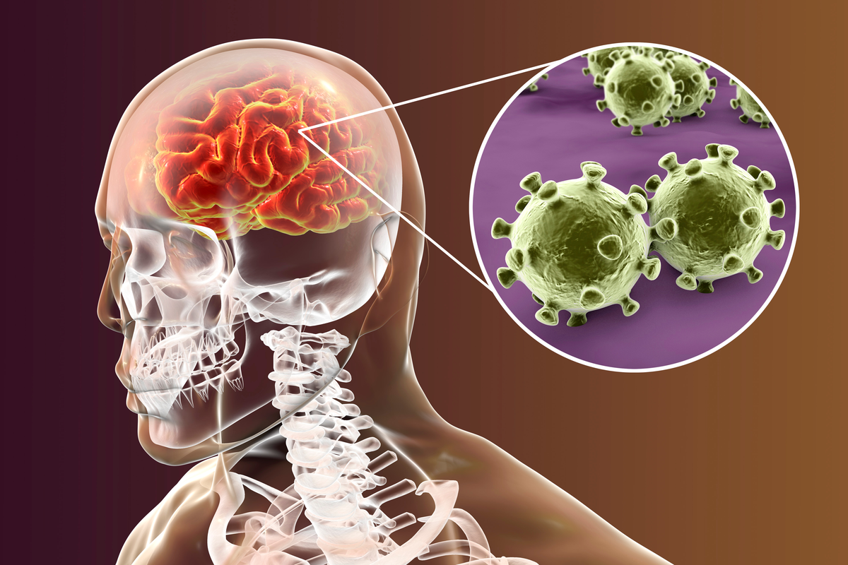 Meningitis Gehirn